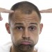 alopecia-masculina